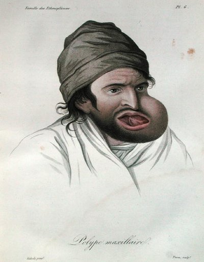 Baron Jean Louis Alibert
