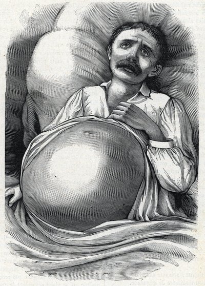 İleri karaciğer sirozu olan hasta (gravür) 1888 by French School