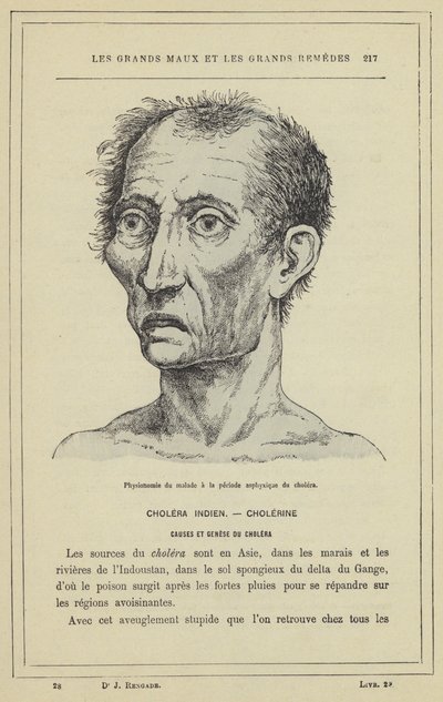 Kolera asfiksi döneminde hastanın fizyonomisi (renkli taş) by French School