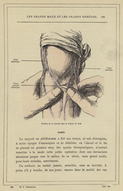 Neşterin kol kanamasındaki konumu (renkli taş) by French School