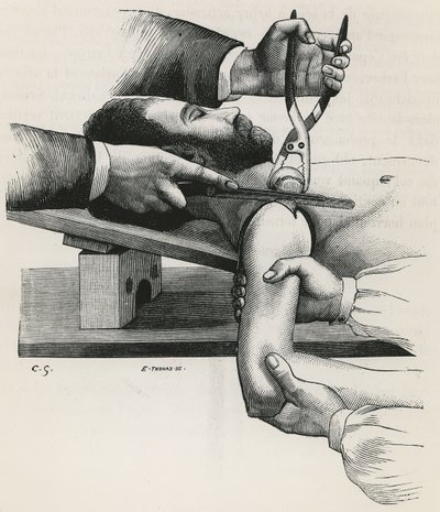 Louis-Hubert Farabeuf'un "Précis de Manuel Operatoire" adlı eserinden omzun rezeksiyonu by French School
