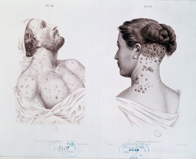 Erkeklerde ve kadınlarda frengi belirtileri, bir tıp kitabından, c.1850-60 by French School