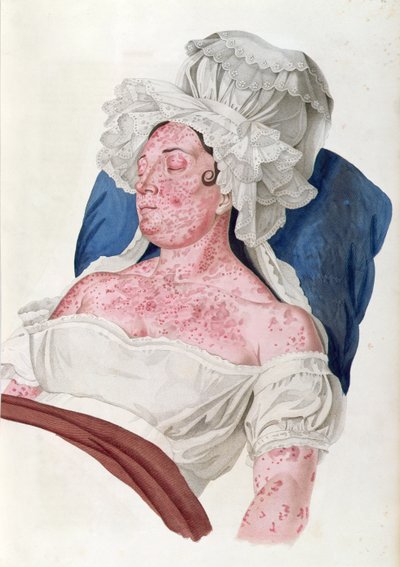 Baron Jean Louis Alibert