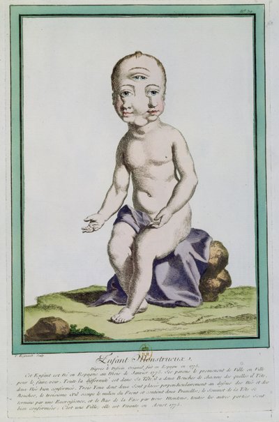 Başı Deforme Olan Çocuk, 