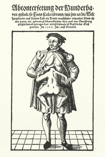 Hans Kaltenbrunn ve gelişmemiş yapışık ikizi (gravür) by German School