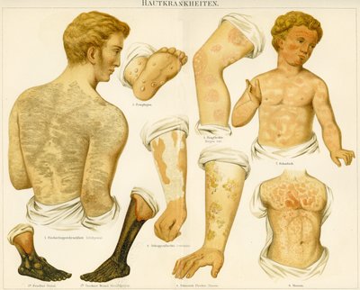 Cilt bozuklukları, c.1890 by German School