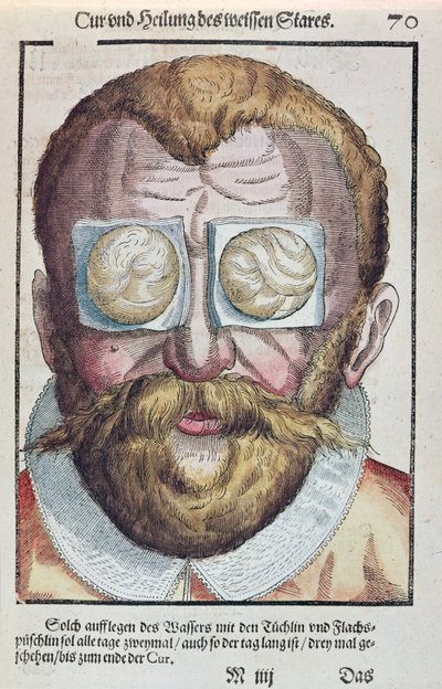 Bir göz rahatsızlığının tedavisi, Georg Bartisch (1535-1636) tarafından Dresden