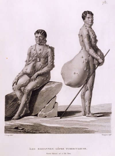 Kuzey Mariana Adaları: Bourgeois tarafından kazınmış 'Voyage Autour du Monde sur les Corvettes de L'Uranie 1817-20'den Tüberkülozdan Acı Çeken İki Adam, 1825 yayınlandı by Jacques Etienne Victor Arago