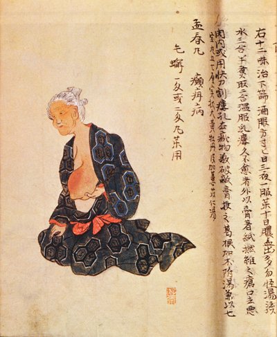 1804 yılında Seishu Hanaoka (1760-1836) tarafından genel anestezi altında gerçekleştirilen meme kanserinin ilk cerrahi tedavisi by Japanese School