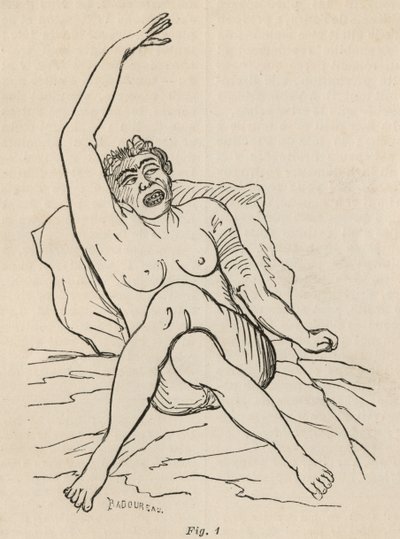 Histerik epilepsi, atak, bükülmeler, şek. 1, Bourneville et P. Regnard, Paris, 1876 tarafından 