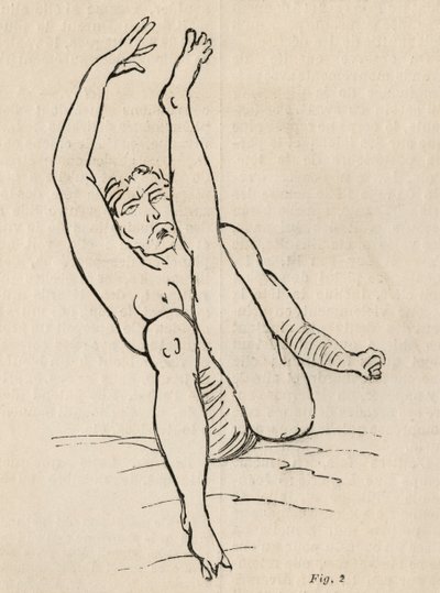 Histerik epilepsi, atak, bükülmeler, şek. 2, Bourneville et P. Regnard, Paris, 1876 tarafından 