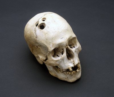 Trephination Bronz Çağı kafatası, Jericho, Filistin, MÖ 2200-2000 by Unbekannt Unbekannt