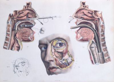 Bir Burun Ameliyatı, Jean-Baptiste Marc Bourgery (1797-1849) 1866-67'nin 'Traite Complet de l'Anatomie de l'Homme'dan bir levha by Nicolas Henri Jacob