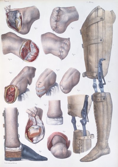 Ampütasyonlar ve Protezler, Jean-Baptiste Marc Bourgery (1797-1849) 1866-67'nin 'Traite Complet de l'Anatomie de l'Homme' adlı eserinden plak by Nicolas Henri Jacob