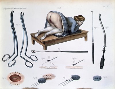 Vezikovajinal fistül üzerinde bir operasyon, Jean-Baptiste Marc Bourgery (1797-1849) 1866-67 (renkli gravür) tarafından 