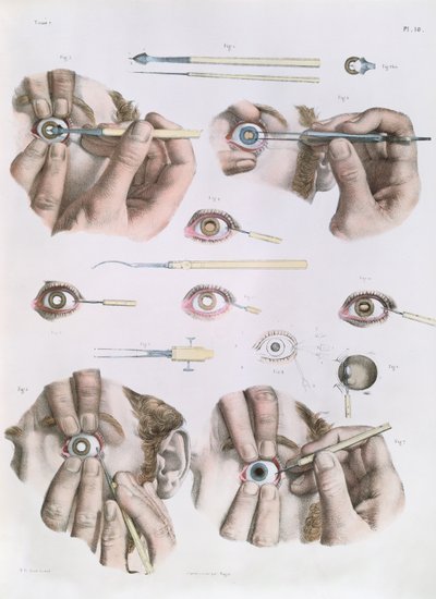 Göz üzerinde operasyon, Jean-Baptiste Marc Bourgery (1797-1849) 1866-67'nin 'Traite Complet de l'Anatomie de l'Homme'dan bir plaka by Nicolas Henri Jacob