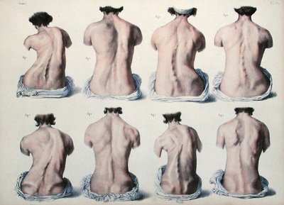 Omurga Deformiteleri, Jean-Baptiste Marc Bourgery (1797-1849) 1866-67 (renkli gravür) tarafından 