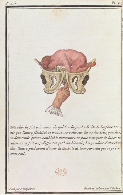 Madame Angelique Le Boursier du Coudray'in (1714-94) bir kitabından, J. Robert tarafından oyulmuş, kolla rahimden çekilen bir bebeğin kesit diyagramı, 1783 by P. Chapparre