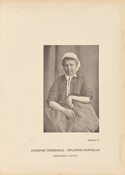 Beyin atrofisi: Parsiyel epilepsi Sol hemipleji by Paul Marie Léon Regnard