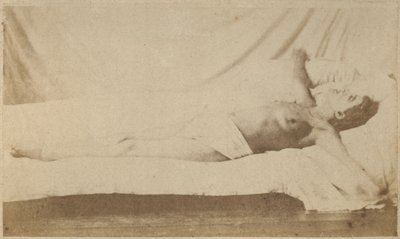 Histerik epilepsi, saldırı, çarmıha germe, Bourneville ve P. Regnard, Paris, 1876