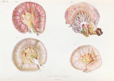 Kolera ile enfekte olmuş bağırsakların dış yüzeyi, Anatomie Pathologique du Cholera Morbus