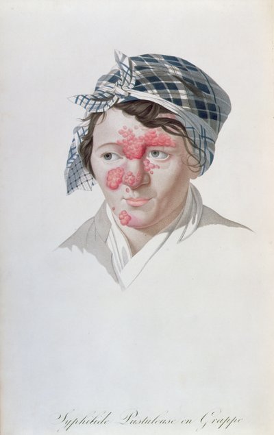 Sifilik küme püstülleri, Baron Jean Louis Alibert
