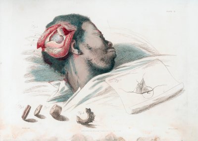 Trepanasyon sonrası kafatasındaki yaranın görünümü ve sol altta parçalanmış kemik parçasının çıkarılması, 1821 by Thomas Landseer