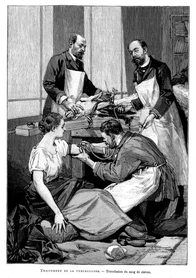 Keçi kanının transfüzyonu yapılan bir tüberküloz hastası, 1891 by Unbekannt