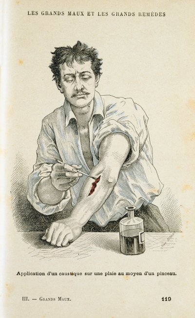 Bir yarayı antiseptik solüsyonla boyamak, c1890 by Unbekannt