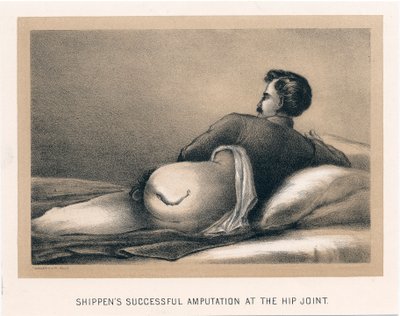 Kalça Ekleminde Başarılı Ampütasyon Gönderiyor, Amerikan İç Savaşı, 1865 by Unbekannt