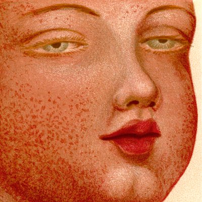 Erüptif Ateşler: Scarlatina veya Scarlet Fever by Unknown artist
