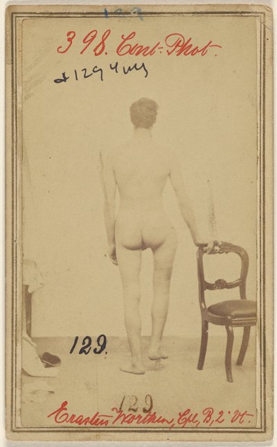 Femurun üst üçte birlik kısmında kırık. Erastus Worthen, Corp Co. B. 2nd Vermont Vols. 25 yaşında - İkamet Stockbridge VT. by Unknown artist