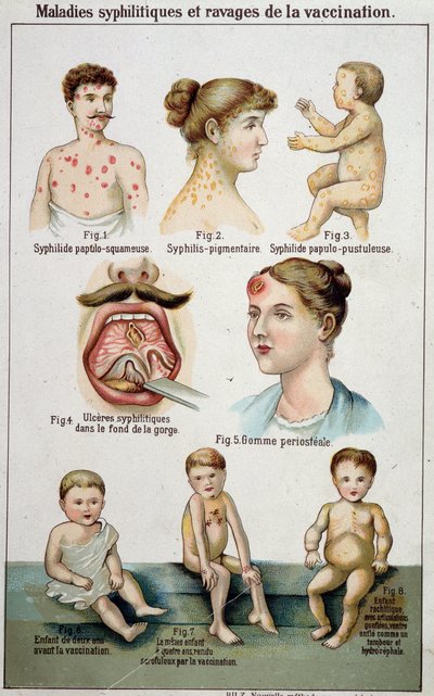 Frengi hastalıklarının farklı yatakhanelerini ve aşılamanın tehlikelerini gösteren levha - 19. yüzyılın sonlarında Bilz doğal tıbbında. by Unknown artist