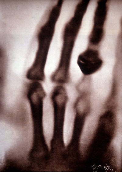 Röntgen ışınları (Röntgen) veya X ışınları İlk fotoğraf: Röntgen