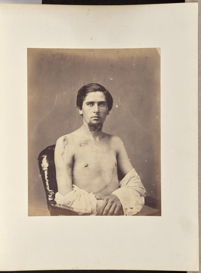 Sağ Humerus Başının Başarılı Eksizyonu by William H. Bell