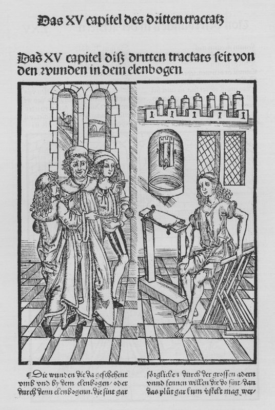 Sirurgia Kitabı, Hieronymus Brunschwig (lito) by (after) German School