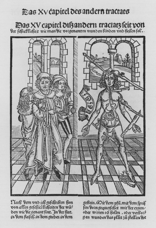Sirurgia Kitabı, Hieronymus Brunschwig (lito) by (after) German School