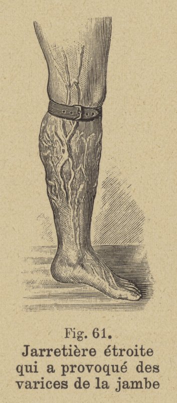 Bacakta varis oluşturan dar jartiyer by German School