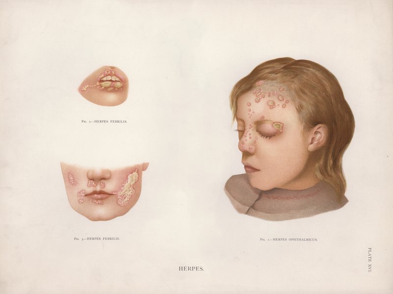 Deri Hastalıkları: Herpes (renkli taş) by English School