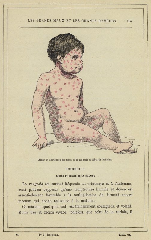 Patlamanın başlangıcında kızamık lekelerinin görünümü ve dağılımı (renkli lito) by French School