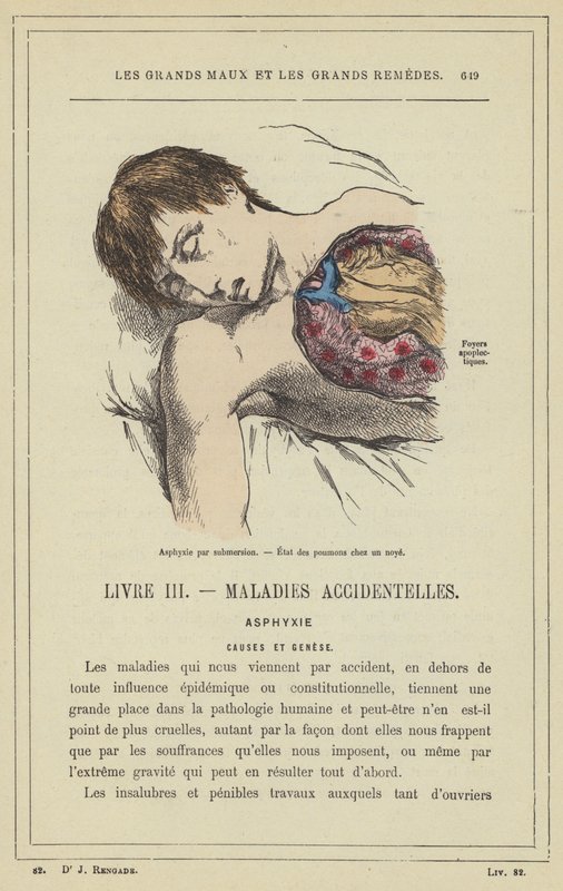 Daldırma yoluyla asfiksi, Akciğerlerin boğulma durumu (renkli taş) by French School