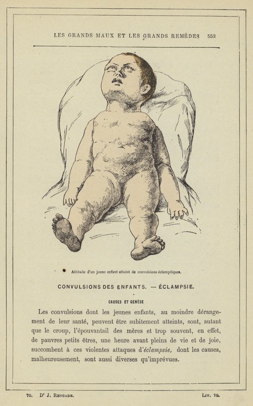 Eklamptik konvülsiyonlu küçük bir çocuğun tutumu (renkli taş) by French School