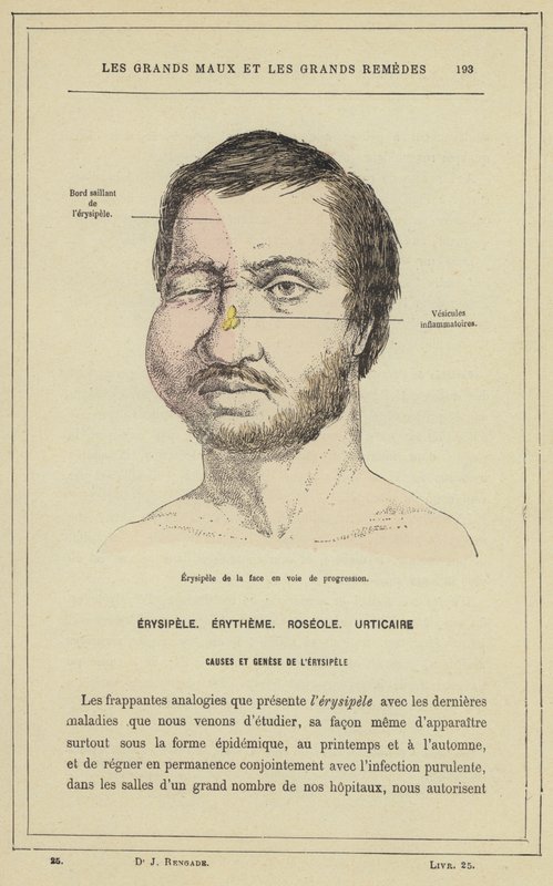 İlerleyen yüzün erizipeli (renkli lito) by French School