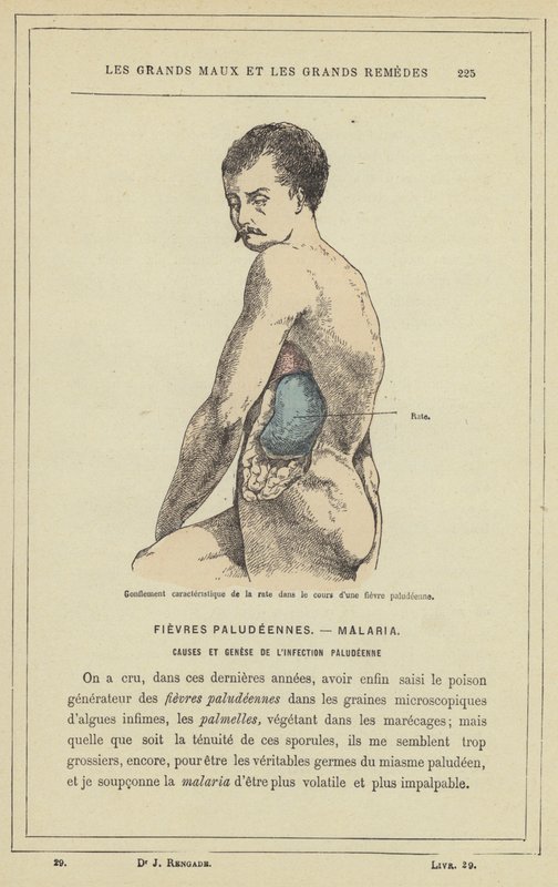 Sıtma ateşi sırasında dalağın karakteristik şişmesi (renkli taş) by French School