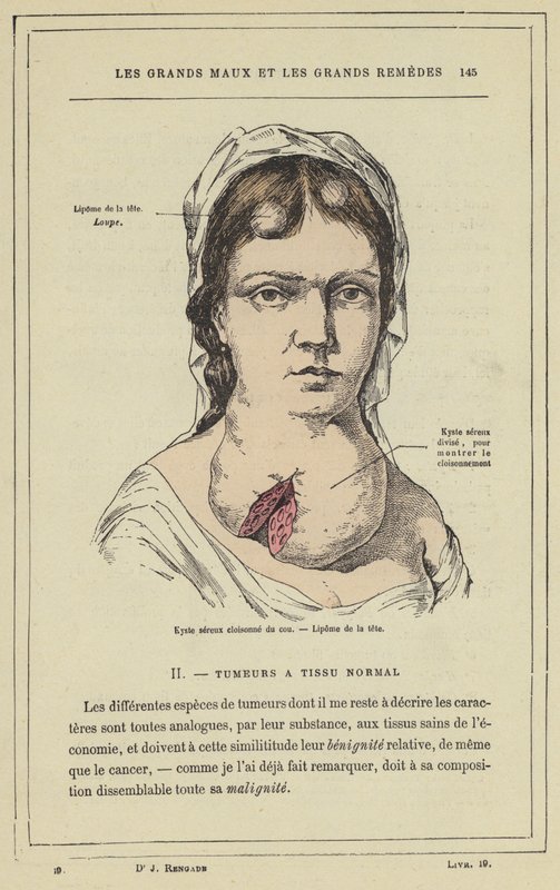 Boynun emaye işi seröz kisti, Başın lipomu (renkli lito) by French School