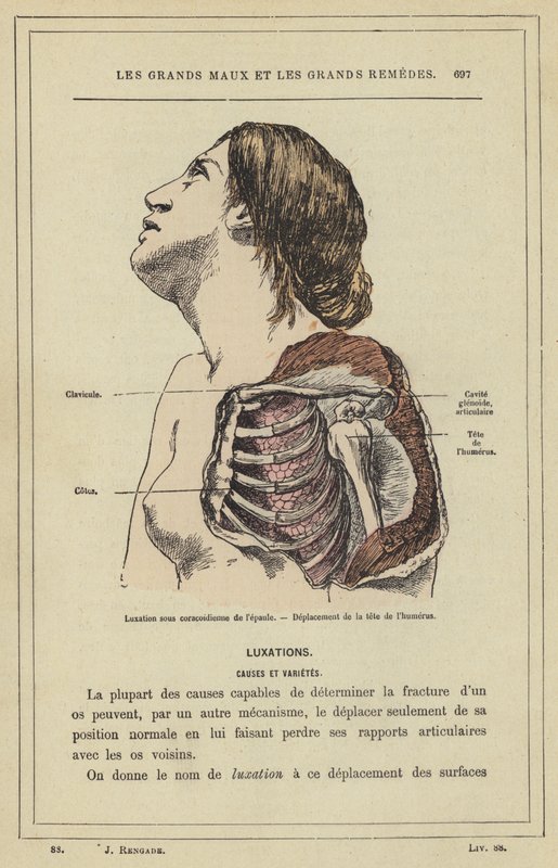 Omuz subkorakoid çıkığı, Humerus başının yer değiştirmesi (renkli taş) by French School