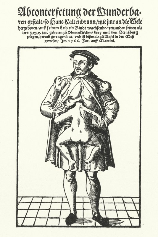 Hans Kaltenbrunn ve gelişmemiş yapışık ikizi (gravür) by German School