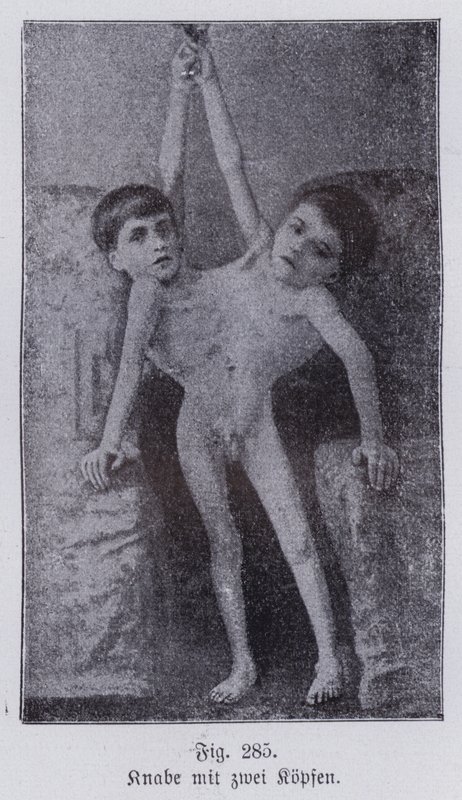 Giacomo ve Giovanni Battista Tocci, İtalyan yapışık ikizler (s/b fotoğraf) by Italian Photographer
